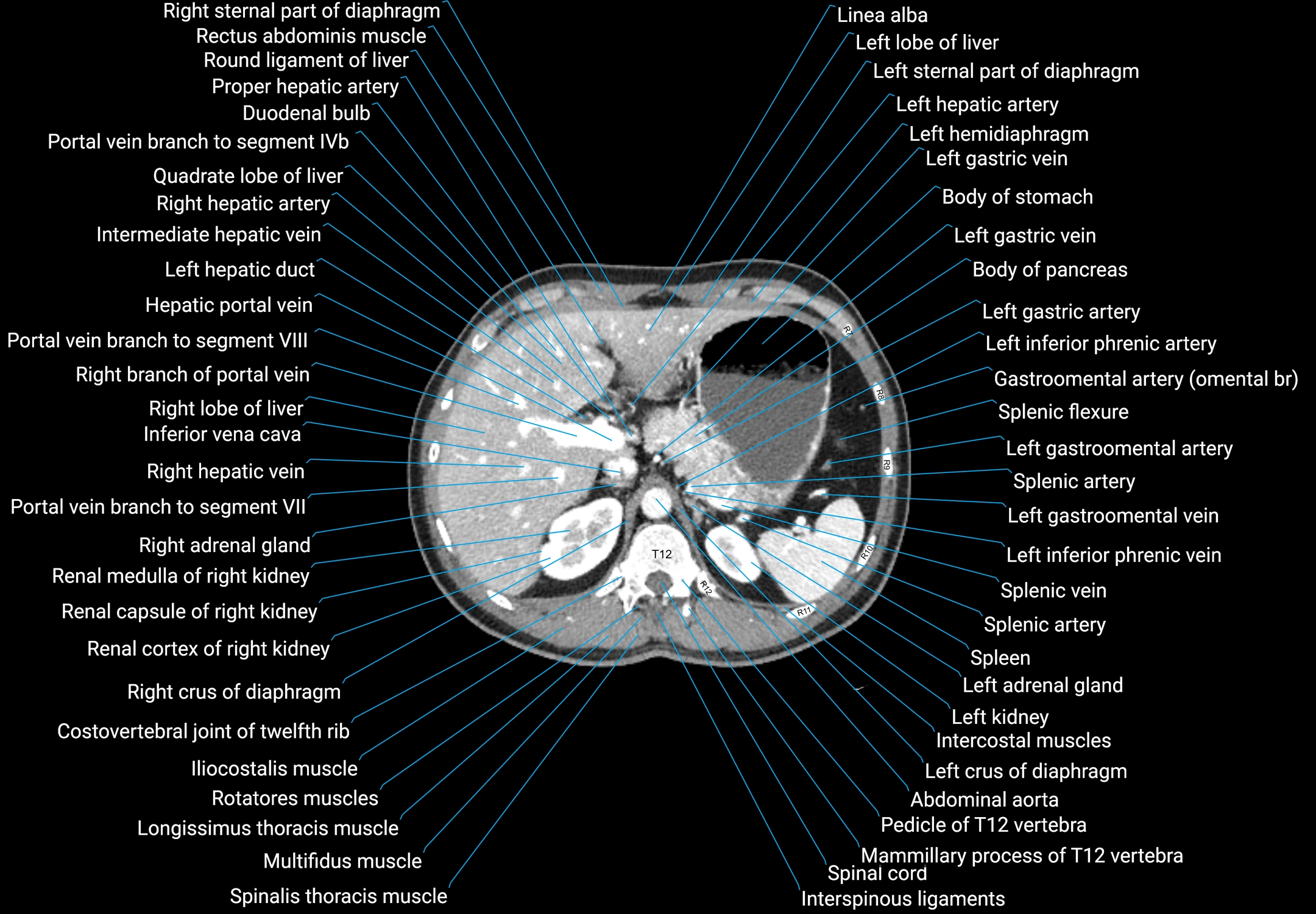 CT male pelvis axial cross sectional anatomy labelled radiology image -00040.webp